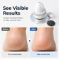 Foot Callus Remover – Vacuum Clean, No Mess